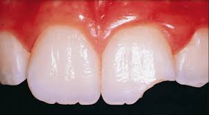 Repair of lost dental filling or damaged crown